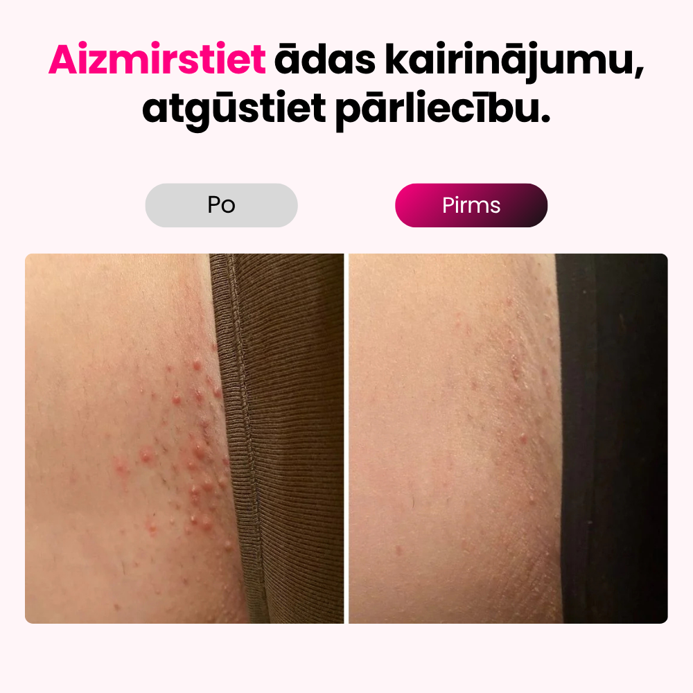 Elumi™ IPL matiņu noņemšanas komplekts