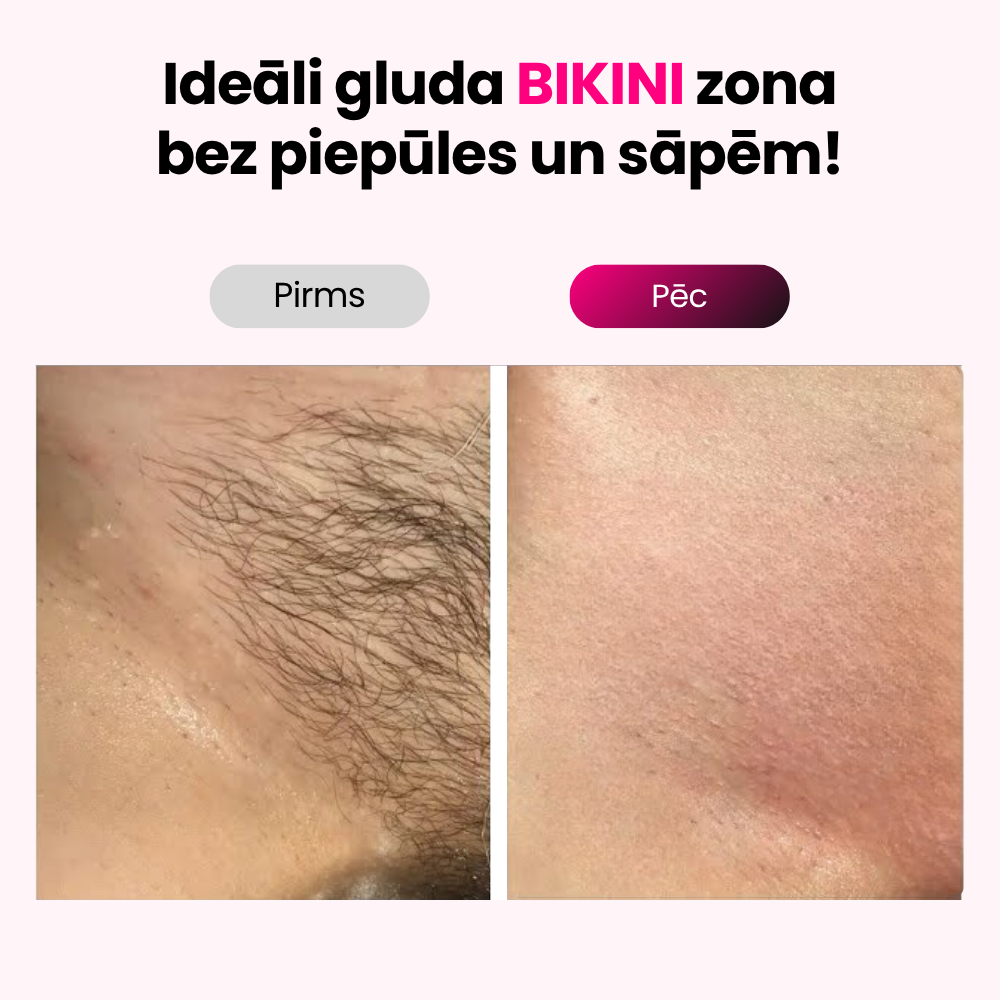 Elumi™ IPL matiņu noņemšanas komplekts
